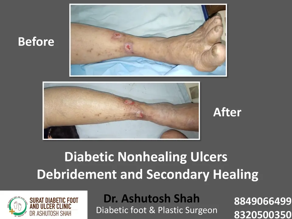 Diabetic Foot  PPT sunita.pptx-49.webp